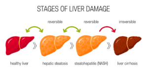 Liver Disease and Detoxification