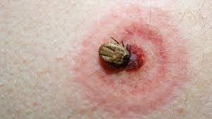 Preventing a tick bite is easier than treating the subsequent infection.